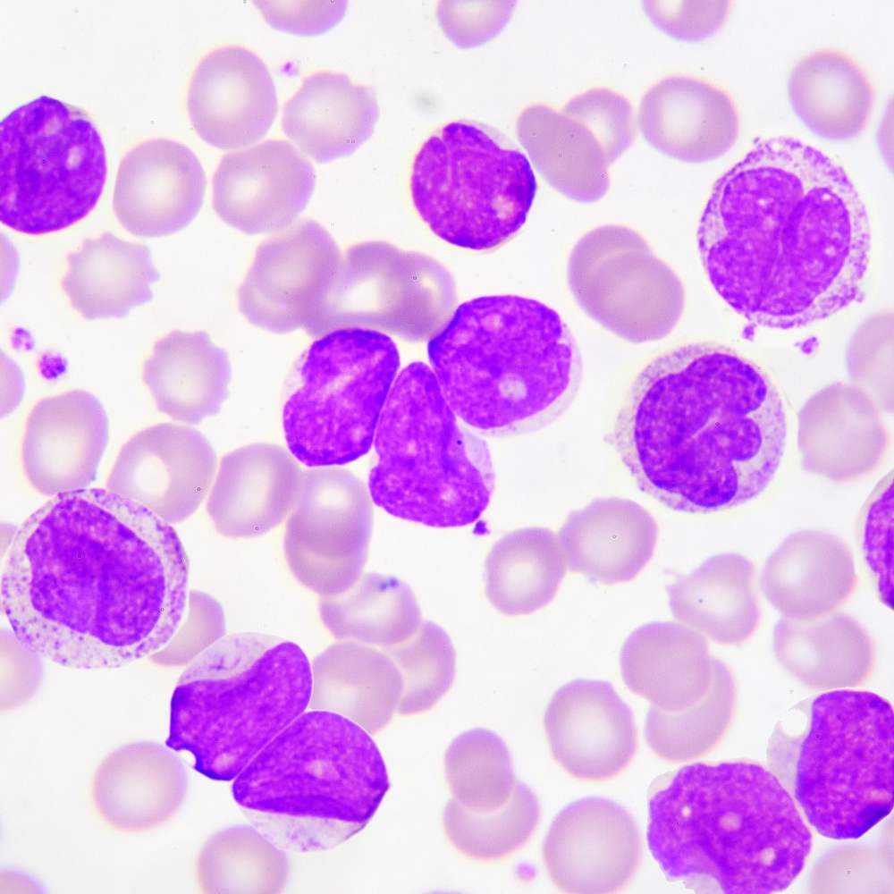 Is Leukemia Cancer Curable? Exploring Advances and Hope for Patients